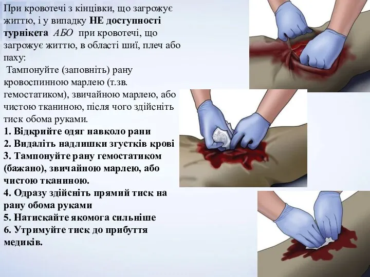 При кровотечі з кінцівки, що загрожує життю, і у випадку