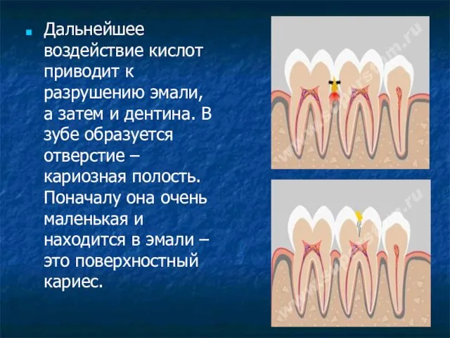 Дальнейшее воздействие кислот приводит к разрушению эмали, а затем и