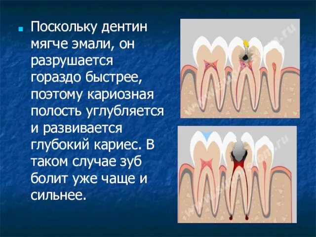 Поскольку дентин мягче эмали, он разрушается гораздо быстрее, поэтому кариозная