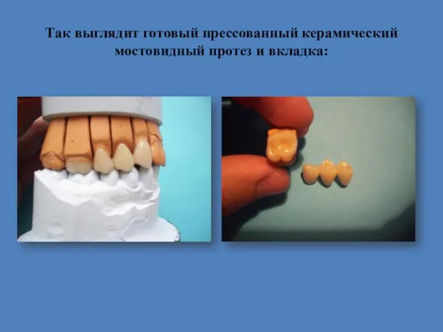 Так выглядит готовый прессованный керамический мостовидный протез и вкладка: