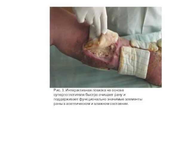 Рис. 3. Интерактивная повязка на основе суперпоглотителя быстро очищает рану