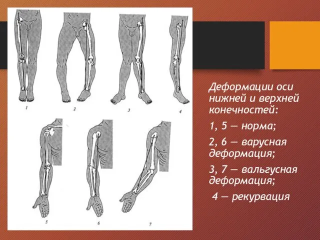 Деформации оси нижней и верхней конечностей: 1, 5 — норма;