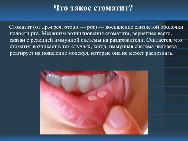Что такое стоматит? Стомати́т (от др.-греч. στόμα — рот) — воспаление слизистой оболочки