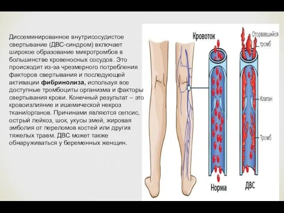 Диссеминированное внутрисосудистое свертывание (ДВС-синдром) включает широкое образование микротромбов в большинстве