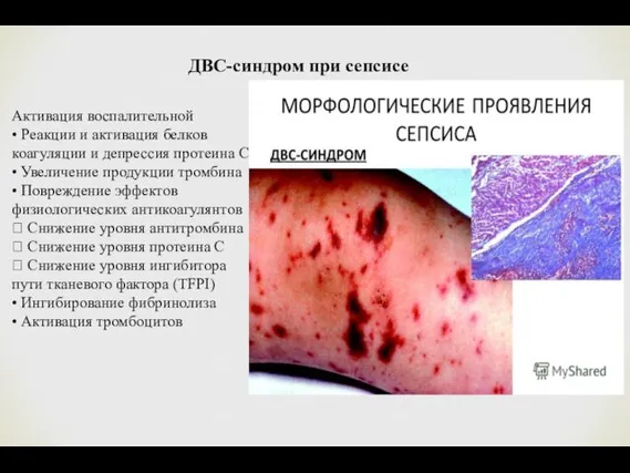 ДВС-синдром при сепсисе Активация воспалительной • Реакции и активация белков