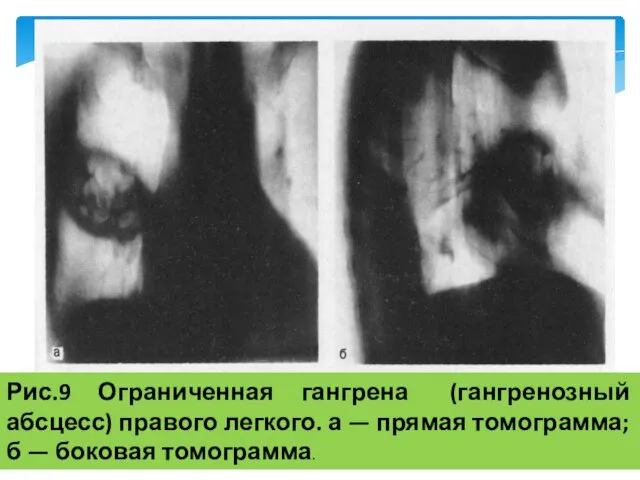 Рис.9 Ограниченная гангрена (гангренозный абсцесс) правого легкого. а — прямая томограмма; б — боковая томограмма.