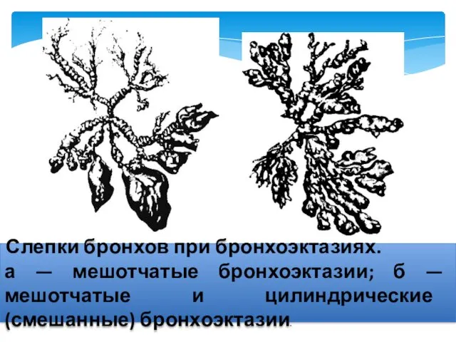 Слепки бронхов при бронхоэктазиях. а — мешотчатые бронхоэктазии; б — мешотчатые и цилиндрические (смешанные) бронхоэктазии.