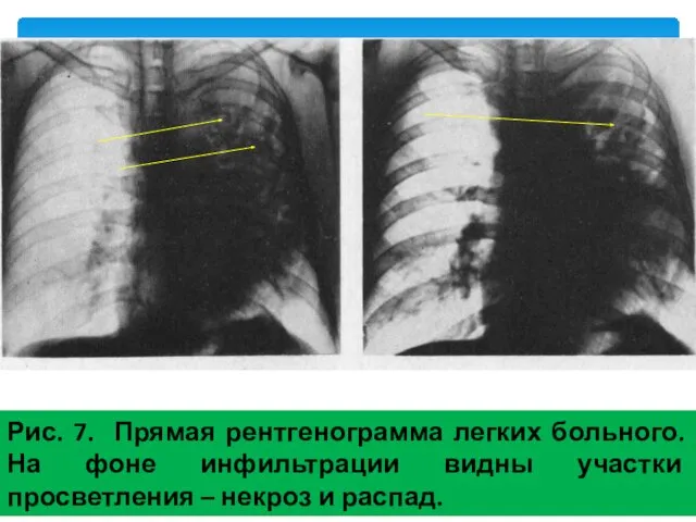 Рис. 7. Прямая рентгенограмма легких больного. На фоне инфильтрации видны участки просветления – некроз и распад.