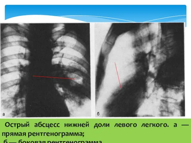 Острый абсцесс нижней доли левого легкого. а — прямая рентгенограмма; б — боковая рентгенограмма.