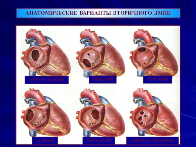АНАТОМИЧЕСКИЕ ВАРИАНТЫ ВТОРИЧНОГО ДМПП ЦЕНТРАЛЬНЫЙ НИЖНИЙ ВЕРХНИЙ ЗАДНИЙ ПЕРЕДНИЙ МНОЖЕСТВЕННЫЕ 12% 60-65% 7.1% 2.5% 7.1%