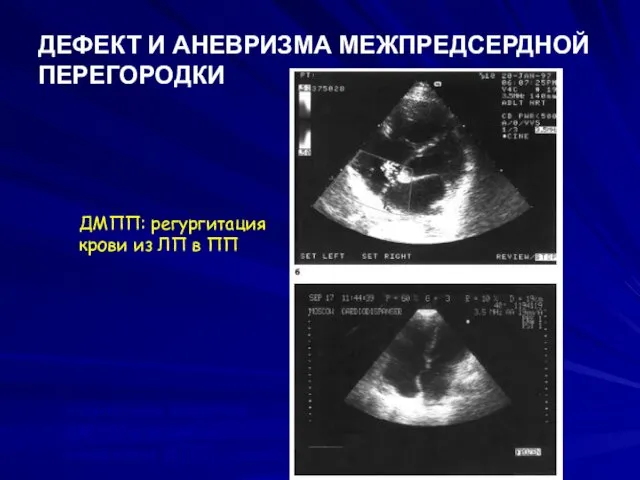 ДЕФЕКТ И АНЕВРИЗМА МЕЖПРЕДСЕРДНОЙ ПЕРЕГОРОДКИ ДМПП: регургитация крови из ЛП