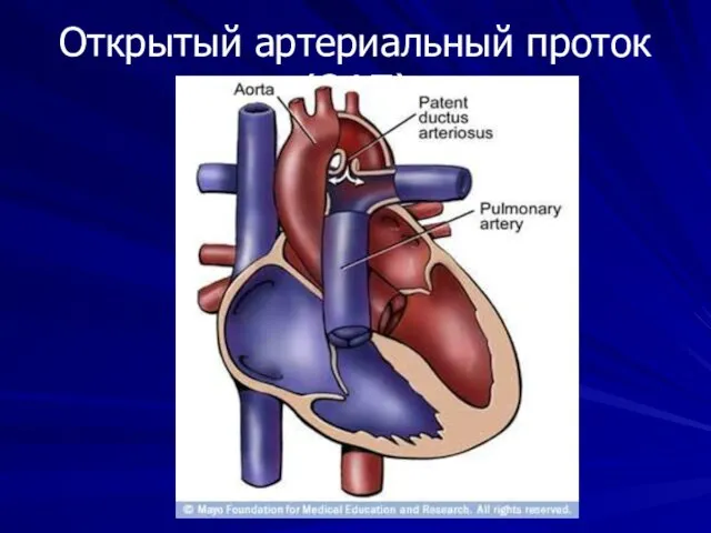Открытый артериальный проток (ОАП)