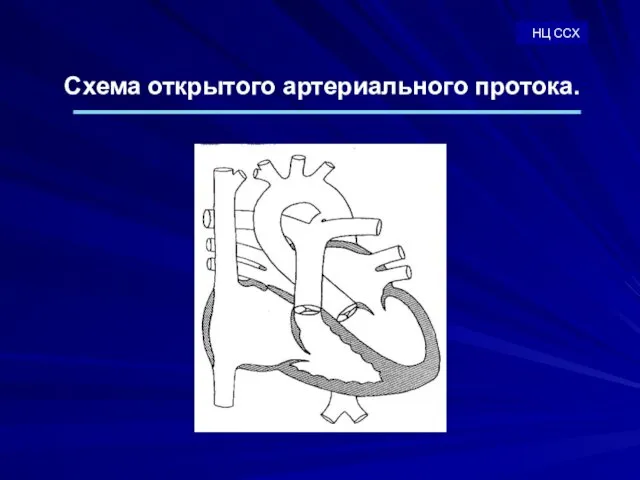 Схема открытого артериального протока. НЦ ССХ