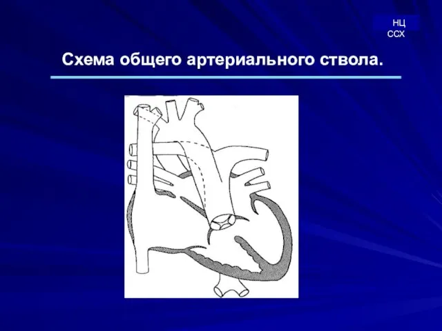 Схема общего артериального ствола. НЦ ССХ