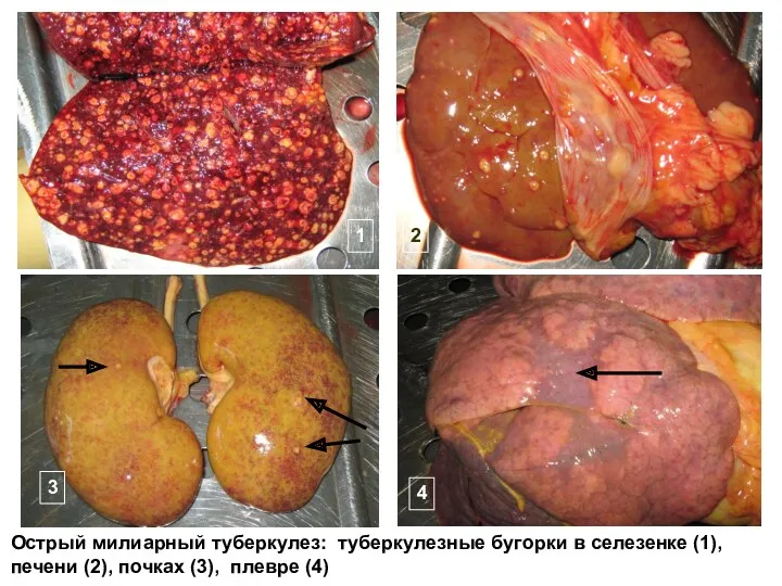 Острый милиарный туберкулез: туберкулезные бугорки в селезенке (1), печени (2),
