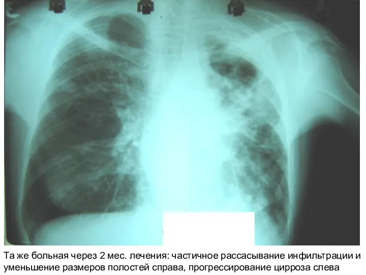 Та же больная через 2 мес. лечения: частичное рассасывание инфильтрации