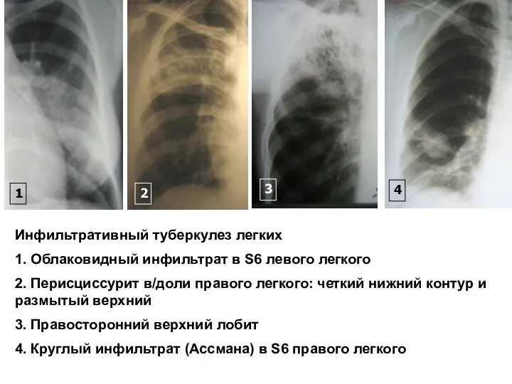 Инфильтративный туберкулез легких 1. Облаковидный инфильтрат в S6 левого легкого