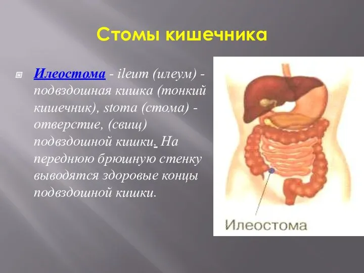 Стомы кишечника Илеостома - ileum (илеум) - подвздошная кишка (тонкий