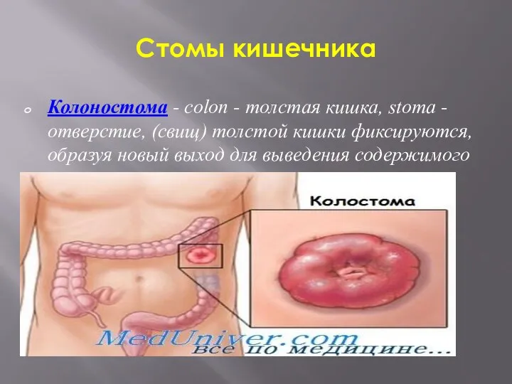 Стомы кишечника Колоностома - colon - толстая кишка, stoma -