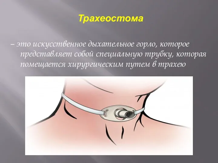 Трахеостома – это искусственное дыхательное горло, которое представляет собой специальную
