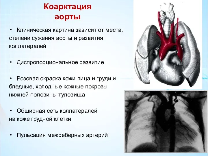 Коарктация аорты Клиническая картина зависит от места, степени сужения аорты