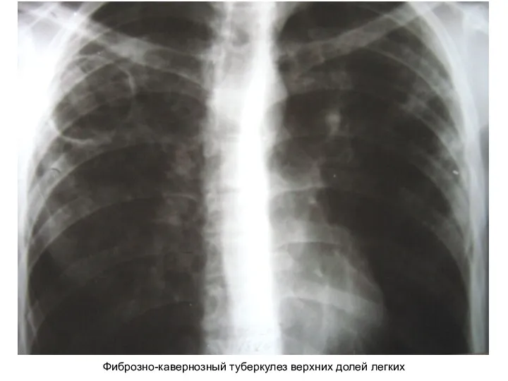 Фиброзно-кавернозный туберкулез верхних долей легких