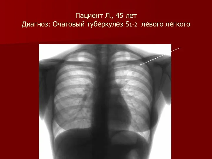 Пациент Л., 45 лет Диагноз: Очаговый туберкулез S1-2 левого легкого