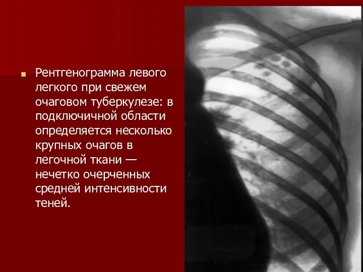 Рентгенограмма левого легкого при свежем очаговом туберкулезе: в подключичной области