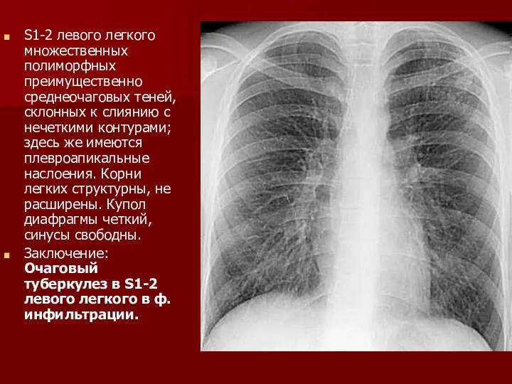 S1-2 левого легкого множественных полиморфных преимущественно среднеочаговых теней, склонных к