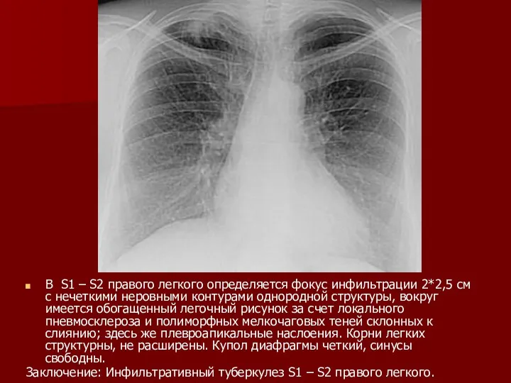 В S1 – S2 правого легкого определяется фокус инфильтрации 2*2,5