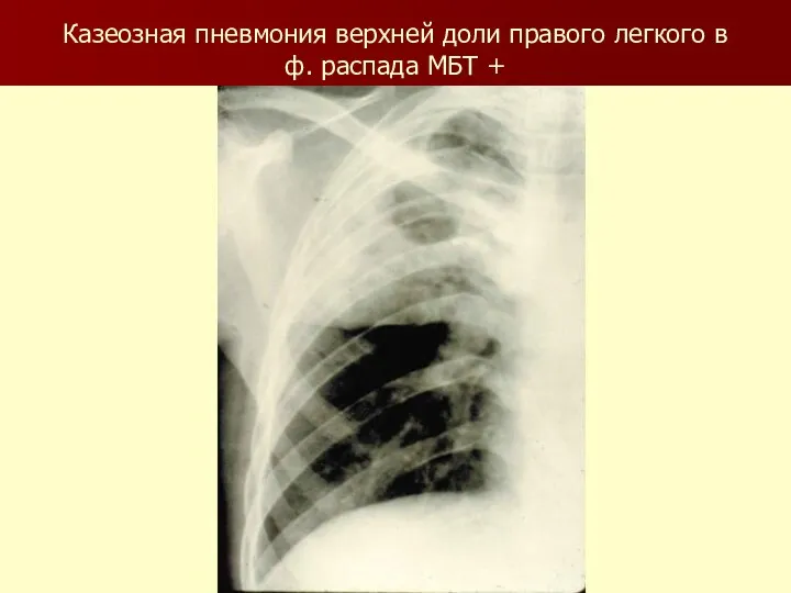 Казеозная пневмония верхней доли правого легкого в ф. распада МБТ +