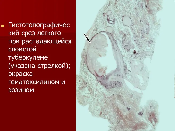 Гистотопографический срез легкого при распадающейся слоистой туберкулеме (указана стрелкой); окраска гематоксилином и эозином