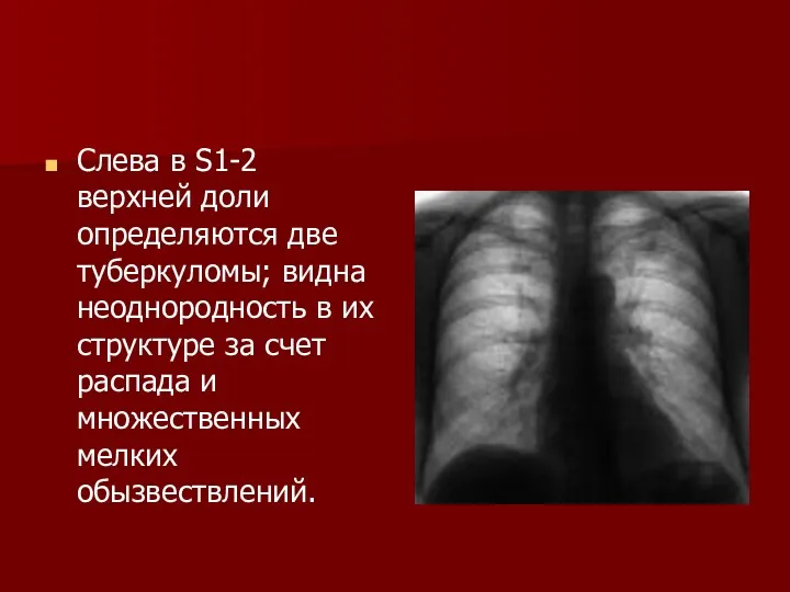 Слева в S1-2 верхней доли определяются две туберкуломы; видна неоднородность