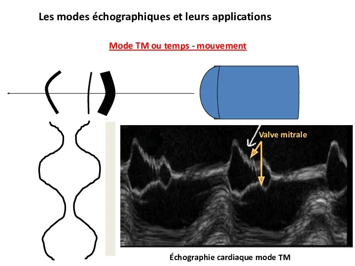 Les modes échographiques et leurs applications Mode TM ou temps - mouvement Échographie cardiaque mode TM