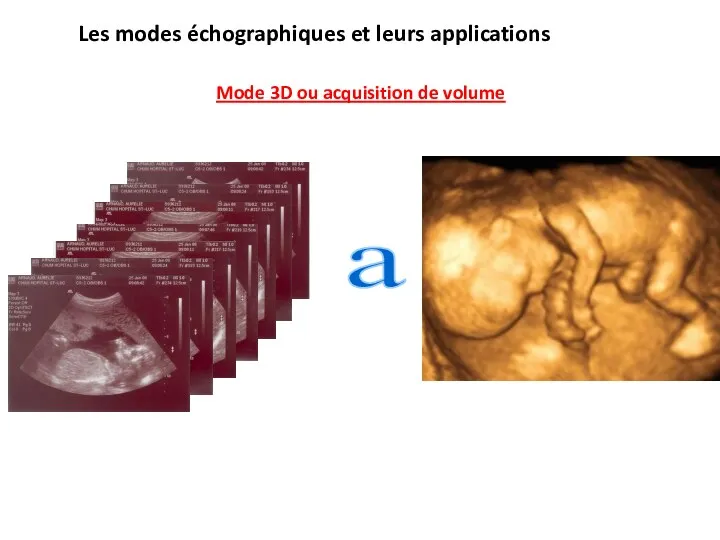 Les modes échographiques et leurs applications Mode 3D ou acquisition de volume a
