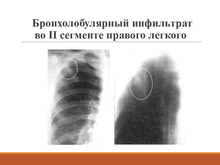 Бронхолобулярный инфильтрат во II сегменте правого легкого