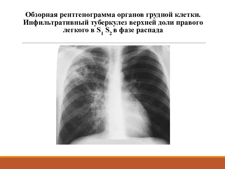 Обзорная рентгенограмма органов грудной клетки. Инфильтративный туберкулез верхней доли правого