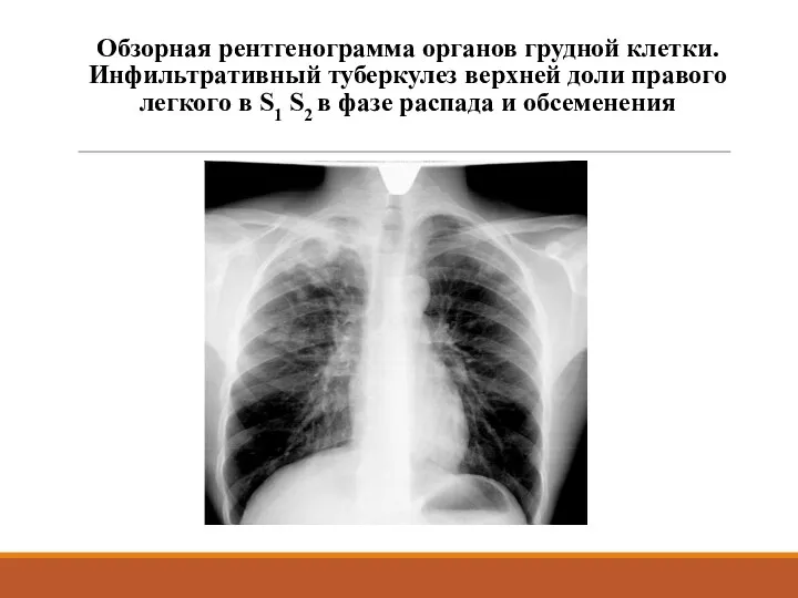 Обзорная рентгенограмма органов грудной клетки. Инфильтративный туберкулез верхней доли правого