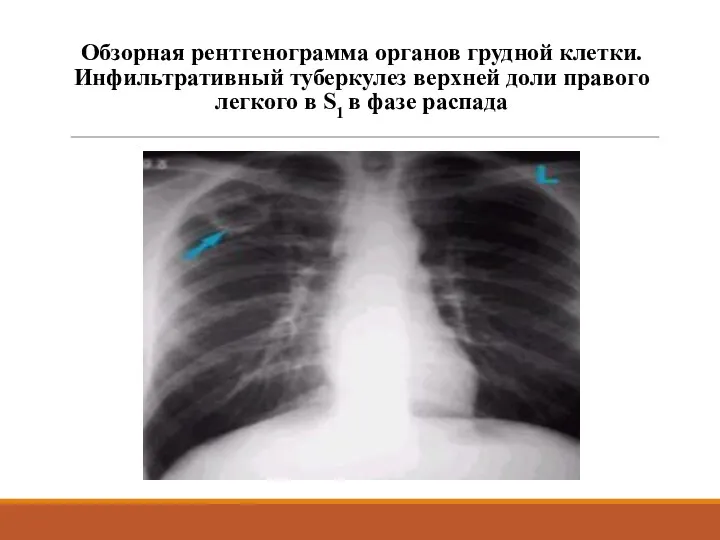 Обзорная рентгенограмма органов грудной клетки. Инфильтративный туберкулез верхней доли правого легкого в S1 в фазе распада