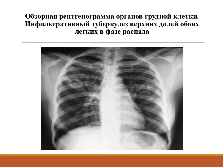 Обзорная рентгенограмма органов грудной клетки. Инфильтративный туберкулез верхних долей обоих легких в фазе распада
