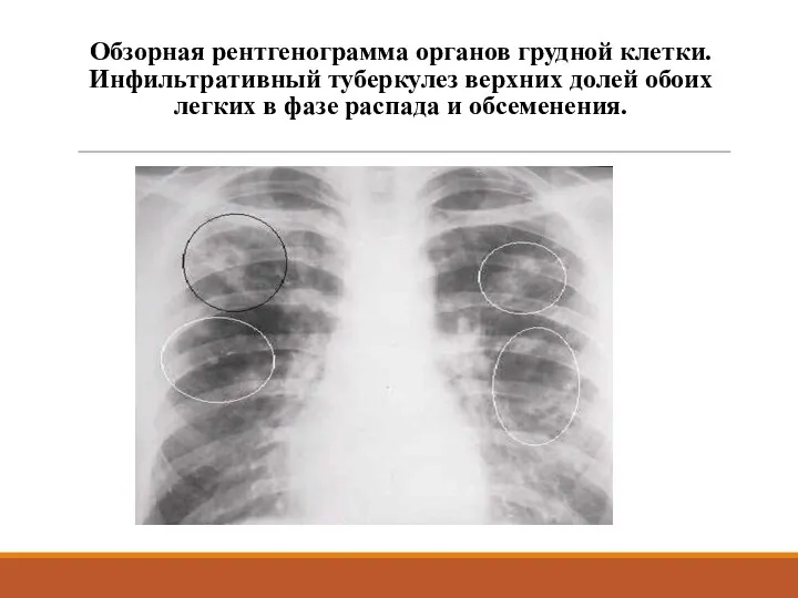 Обзорная рентгенограмма органов грудной клетки. Инфильтративный туберкулез верхних долей обоих легких в фазе распада и обсеменения.
