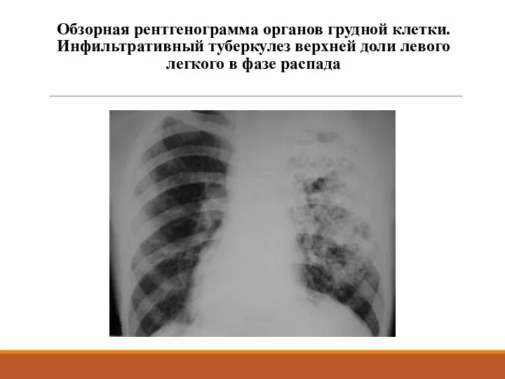 Обзорная рентгенограмма органов грудной клетки. Инфильтративный туберкулез верхней доли левого легкого в фазе распада