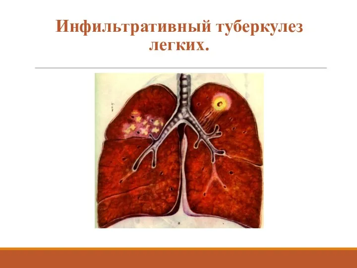 Инфильтративный туберкулез легких.