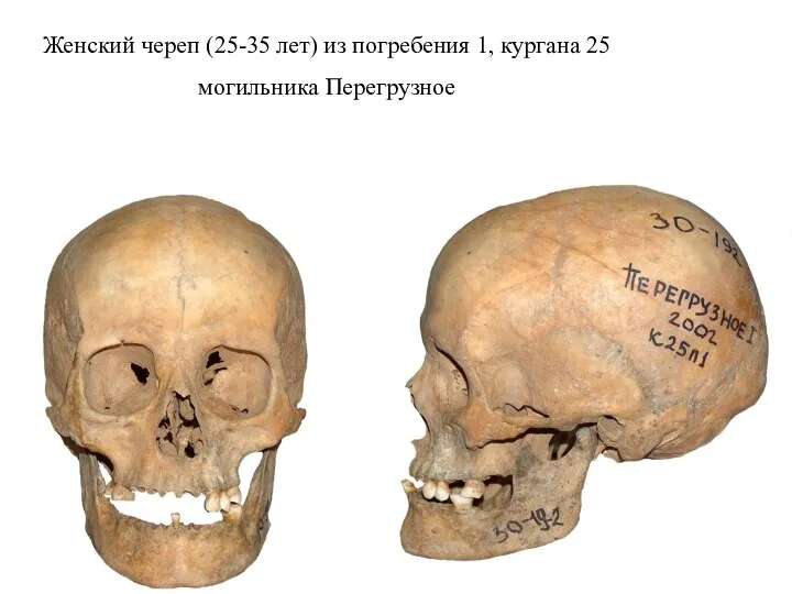 Женский череп (25-35 лет) из погребения 1, кургана 25 могильника Перегрузное