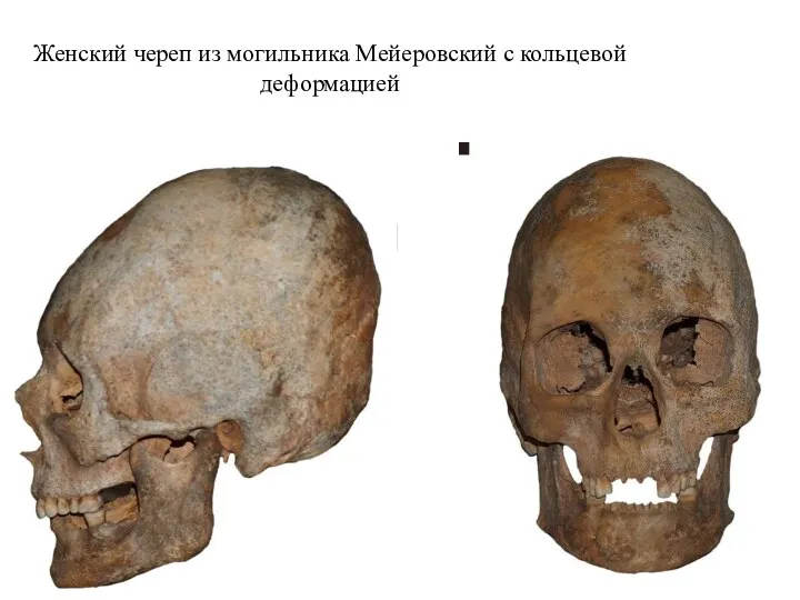 Женский череп из могильника Мейеровский с кольцевой деформацией