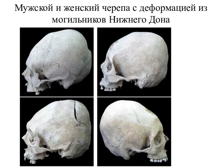 Мужской и женский черепа с деформацией из могильников Нижнего Дона