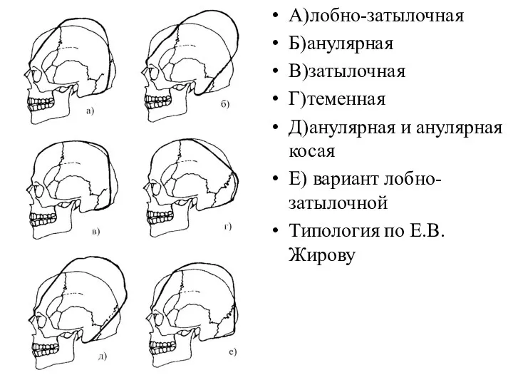 А)лобно-затылочная Б)анулярная В)затылочная Г)теменная Д)анулярная и анулярная косая Е) вариант лобно-затылочной Типология по Е.В.Жирову