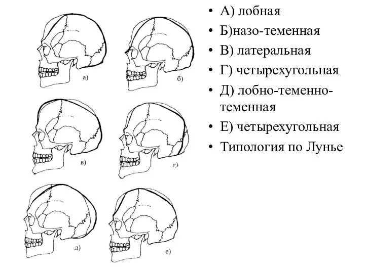 А) лобная Б)назо-теменная В) латеральная Г) четырехугольная Д) лобно-теменно-теменная Е) четырехугольная Типология по Лунье