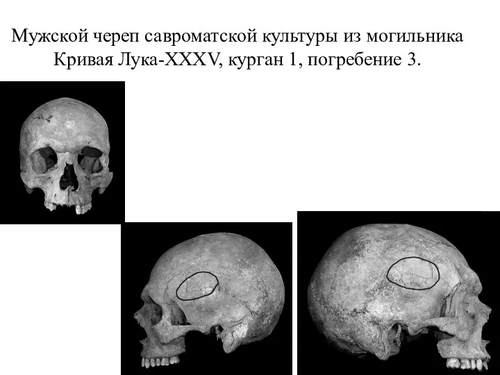 Мужской череп савроматской культуры из могильника Кривая Лука-XXXV, курган 1, погребение 3.