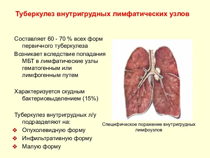 Туберкулез внутригрудных лимфатических узлов Составляет 60 - 70 % всех форм первичного туберкулеза